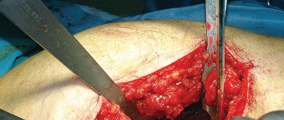 Illustration 42 for Unlock the Figure Posterior Approach to the Hip