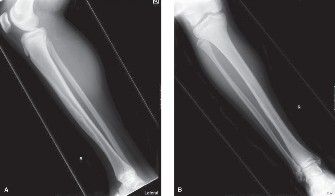 Illustration of oncology cases adamantinoma - Dr. Mohammed Hutaif