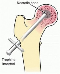 Illustration of osteonecrosis of the femoral - Dr. Mohammed Hutaif