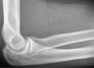 Illustration 3 for Solve Orthopedic Cases: Extensor Carpi Radialis Brevis & Elbow Pain