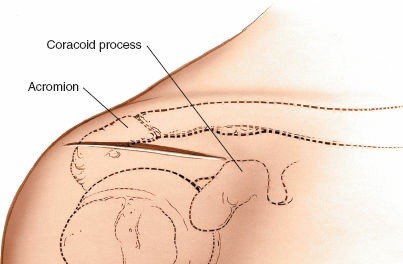 Precision Anterolateral Approach: Joint & Subacromial Surgery Guide