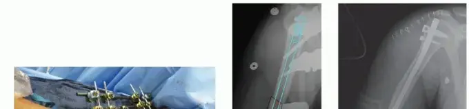 كسور عظم العضد: دليل المريض الشامل للعلاج والتعافي مع الأستاذ الدكتور محمد هطيف