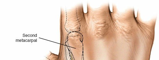 Illustration 5 for Expert Guide: Ulna and Wrist External Fixation Pin Placement