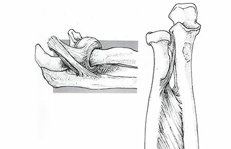 Mastering Radius & Ulna Shaft Fractures: Key Concepts Explained
