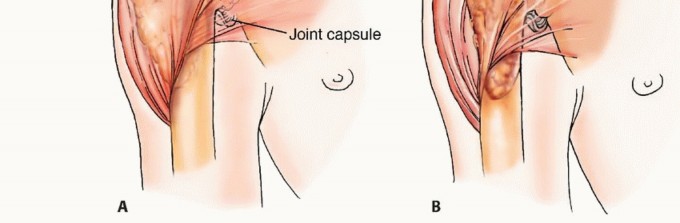 Illustration 24 for Plain Radiograph Showing MBD: Surgical Planning to Prevent Failures