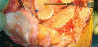 Illustration 37 for Mastering TKA: Essential Methods of Rotational Alignment