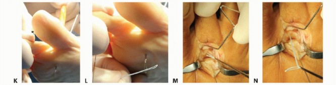 Illustration 37 for Plantar Plate Repair: End Lesser Toe Pain & Instability