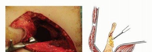 توضيح طبي: جراحة نقائل الحوض: حل شامل لآلام العظام واستعادة الحركة مع الأستاذ الدكتور محمد هطيف