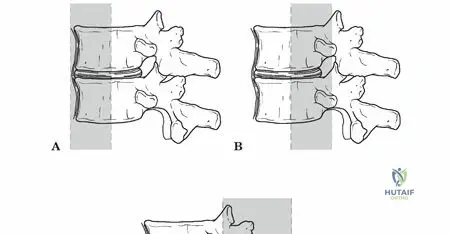 Illustration of spinal stability spinal - Dr. Mohammed Hutaif