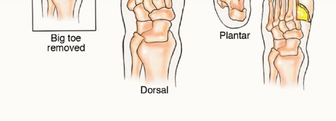 صورة طبية: أورام القدم: دليلك الشامل للعلاج، البتر، والاستئصال مع الأستاذ الدكتور محمد هطيف في صنعاء