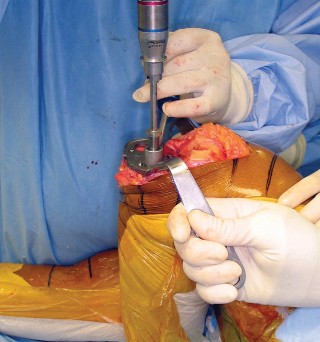 Illustration 10 for Monoblock Total Knee: When to Use & What to Avoid