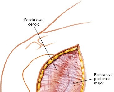 Illustration 18 for Essential Guide: Mastering Every Approach to the Shoulder