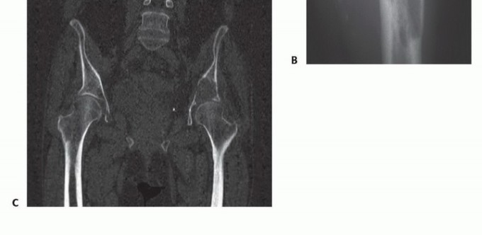 Illustration 12 for Plain Radiograph Showing MBD: Surgical Planning to Prevent Failures