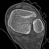 Illustration 15 for Tibial Fracture Extending into the Plafond: Intramedullary Secrets