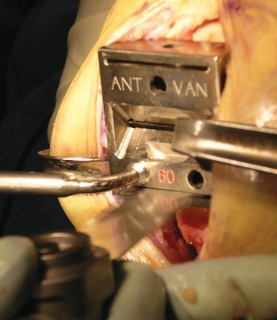 Illustration 20 for Cemented TKA Figure: Your Visual Guide to Surgical Success