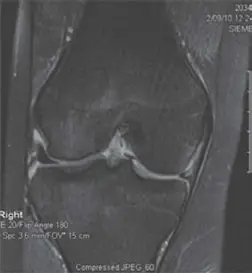 صورة توضيحية لـ تمزق الغضروف الهلالي: دليلك الشامل للتشخيص والعلاج في صنعاء مع الأستاذ الدكتور محمد هطيف