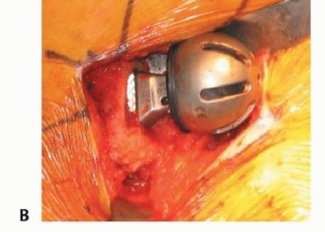 صورة طبية: نصف مفصل الورك: دليلك الشامل لدواعي الاستخدام والأنواع في صنعاء