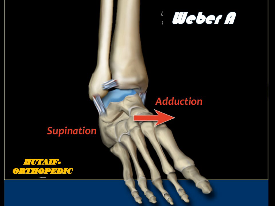 Weber A Ankle Fractures: Comprehensive Review of Anatomy, Biomechanics, and Management