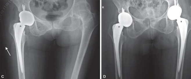 صورة طبية: استبدال مفصل الورك الكلي لالتهاب المفاصل الروماتويدي اليفعي: استعادة الحركة والأمل مع الأستاذ الدكتور محمد هطيف في صنعاء