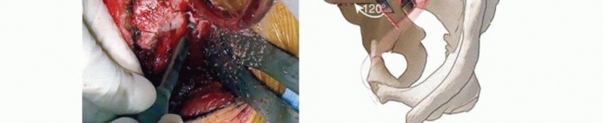 Illustration 20 for Restore Hip Health: Pelvic Osteotomy for Acetabular Dysplasia & CEA of Less