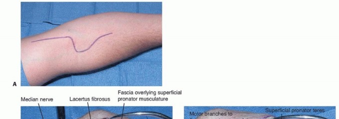 Decompression of Pronator and Anterior Interosseous Syndromes