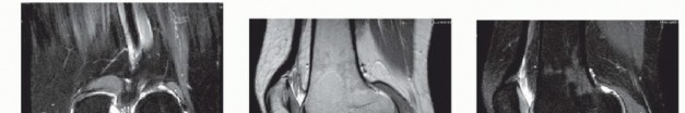 Damaged Cartilage? Explore Fresh Osteochondral Allografts