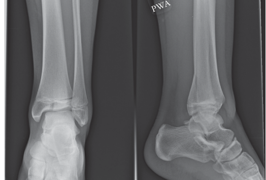Adolescent Distal Tibial Tillaux & Triplane Fractures: Pathophysiology, Diagnosis, and Management