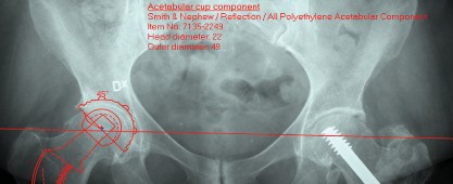 Illustration of femoral stem figure - Dr. Mohammed Hutaif
