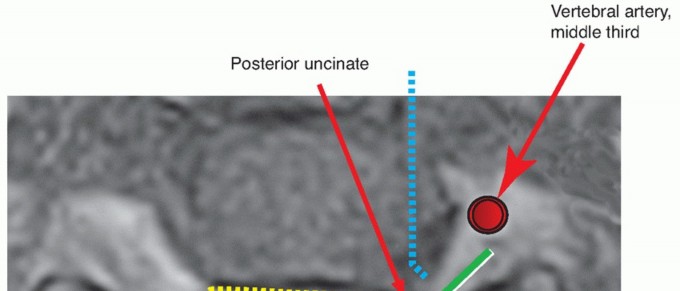 Illustration of posterior disc space - Dr. Mohammed Hutaif