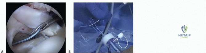 Acute Hand Injuries: Principles of Initial Management and Wound Coverage