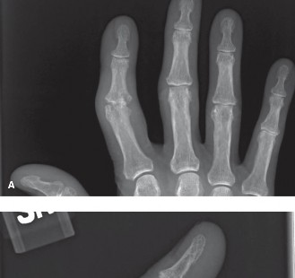 Erosive Osteoarthritis of the Index Finger PIP: Diagnosis & Management