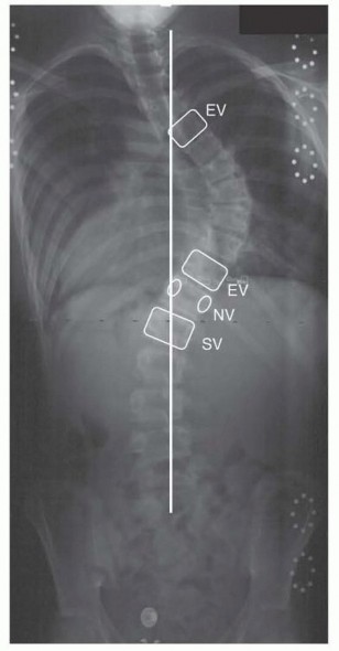 Illustration of spinal fusion for idiopathic - Dr. Mohammed Hutaif
