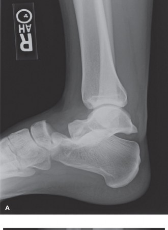 Ankle Reduction Blocked? Check the Extensor Digitorum Brevis