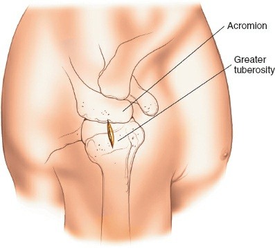 Step-by-Step Guide: Minimally Invasive Approach to the Proximal Humerus