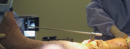 Illustration 22 for Posterior Stabilized Technique: Essential Insights for TKA Success