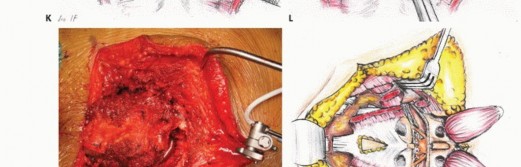 صورة طبية: جراحة أورام العجز: الحفاظ على وظائف الأمعاء والمثانة مع الأستاذ الدكتور محمد هطيف في صنعاء