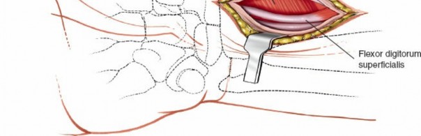 Illustration 56 for Essential Surgical Approaches: Uncover Every Aspect of the Wrist