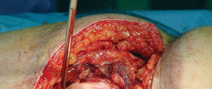 Illustration 31 for Unlock the Figure Posterior Approach to the Hip