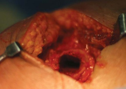 صورة طبية: مفصل الفخذ الصناعي قصير الجذع METHA: حلول مبتكرة للحفاظ على العظم في صنعاء مع الأستاذ الدكتور محمد هطيف