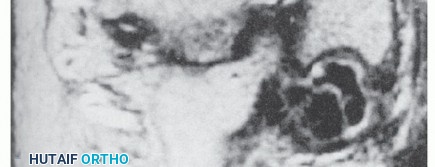 Illustration 11 for Beyond Primary Repair: Solutions for Peroneal Tendon Subluxation