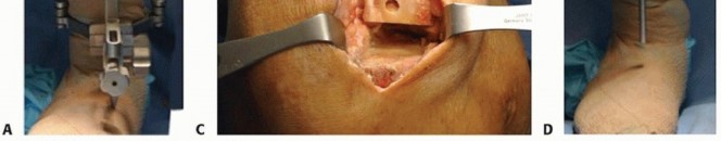 Illustration 14 for Unicondylar Knee Arthroplasty: Is This Your Solution to Knee Pain?