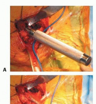 صورة طبية: نصف مفصل الورك: دليلك الشامل لدواعي الاستخدام والأنواع في صنعاء