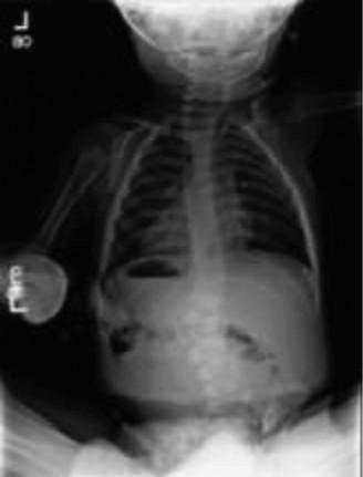 Illustration 2 for Mastering Hemivertebra Unilateral Bar Diagnosis: 12 Cases