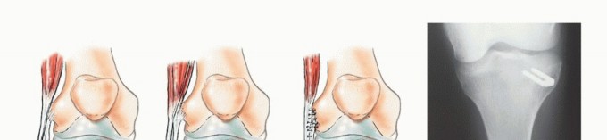 صورة طبية: استئصال أورام الشظية: دليل شامل للعلاج الحديث والحفاظ على الأطراف مع الأستاذ الدكتور محمد هطيف