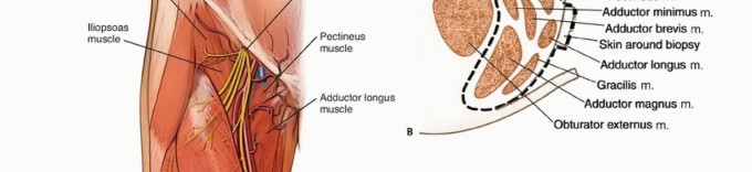 صورة طبية: استئصال أورام العضلات المقربة في الفخذ: الحفاظ على الطرف بتقنيات متقدمة مع الأستاذ الدكتور محمد هطيف في صنعاء