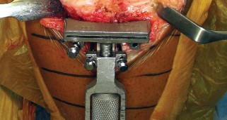 Illustration 7 for Monoblock Total Knee: When to Use & What to Avoid