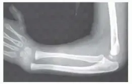 صورة توضيحية لـ تصحيح تشوه نقص عظم الكعبرة (انحراف الرسغ الكعبري): دليل شامل للمرضى مع الأستاذ الدكتور محمد هطيف