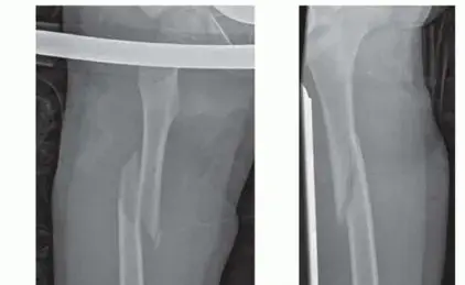 صورة توضيحية لـ كسور عظم الفخذ: دليل شامل للمريض وعلاجها بالمسمار النخاعي المرن مع الأستاذ الدكتور محمد هطيف