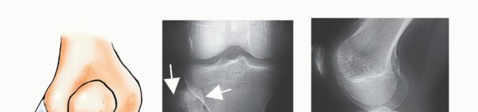 صورة توضيحية لـ استئصال أورام الشظية: دليل شامل للعلاج الحديث والحفاظ على الأطراف مع الأستاذ الدكتور محمد هطيف