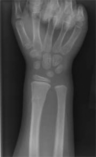 Pediatric Orthopedic Cases: Diagnose & Treat a Child's Wrist Fracture